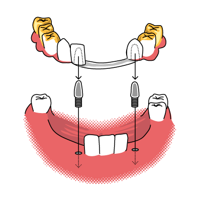 Bild einer teleskopierenden Br&uuml;cke in Gold gearbeitet